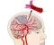 article image for أسباب الجلطة الدماغية