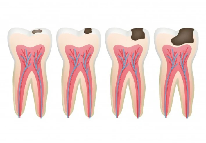 كيف يتم علاج تسوس الأسنان؟