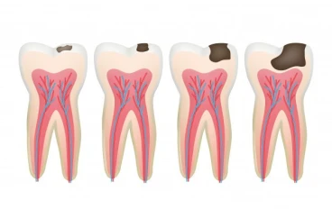 كيف يتم علاج تسوس الأسنان؟