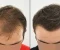 صورة مقال الجديد في تقنيات زراعة الشعر