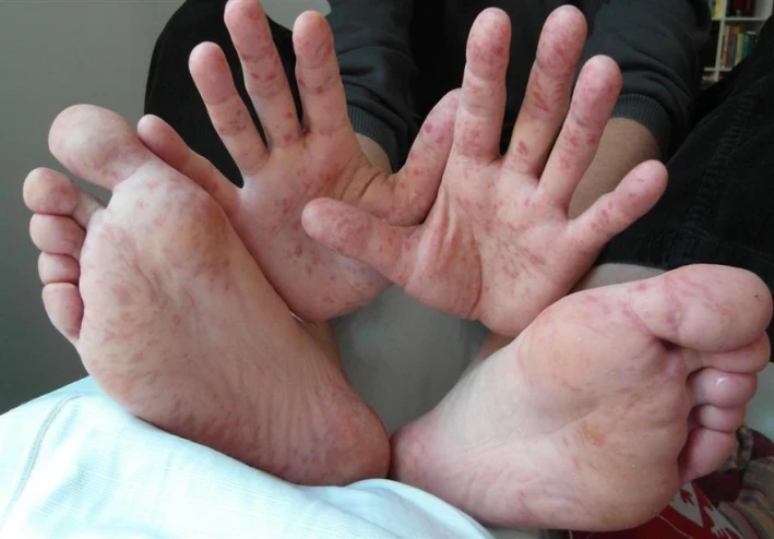 فيرس اليد والقدم والفم hand foot and mouth disease