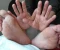 فيرس اليد والقدم والفم hand foot and mouth disease