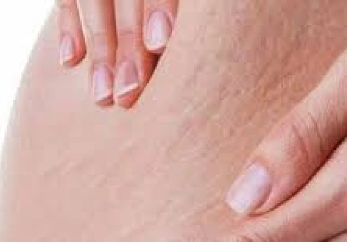 ما هي أسباب السلوليت والخطوط التي تظهر بالجسم وما أنواعها