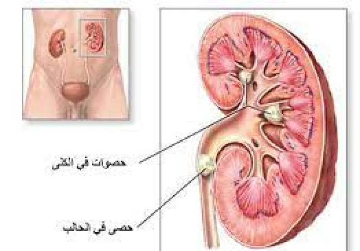 #حصوات الكلي وحصوات الحالب والتخلص منها