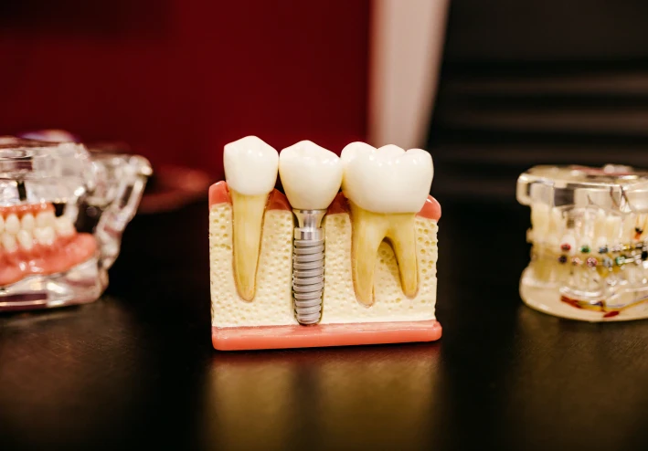 حشوات الاسنان والاستعاضه ف طب الاسنان