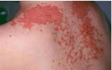 Shingles (Herpes Zoster)