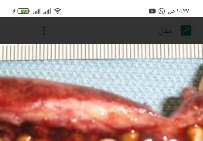 علاج هام لحصوات المرارة ما هو