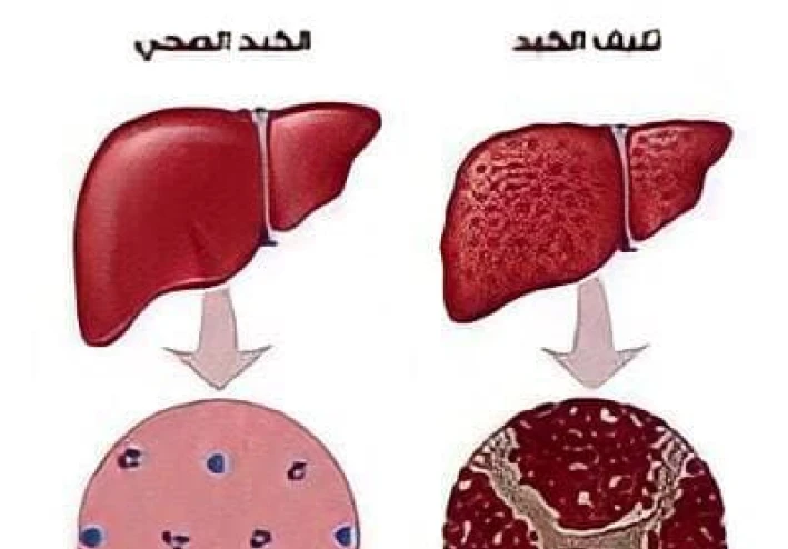 التغذيه السليمه لمريض الكبد المزمن