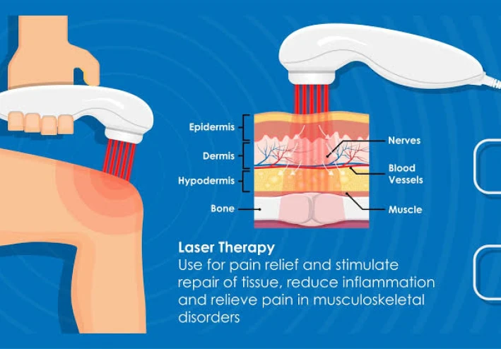 Laser Therapy: The Revolutionary Solution for Chronic Pain Relief with Amazing Effectiveness!
