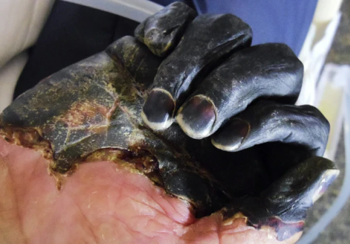 "From Black Death to Modern Prevention: Mastering Bubonic Plague Control in Public Spaces"