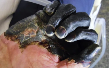 "From Black Death to Modern Prevention: Mastering Bubonic Plague Control in Public Spaces"