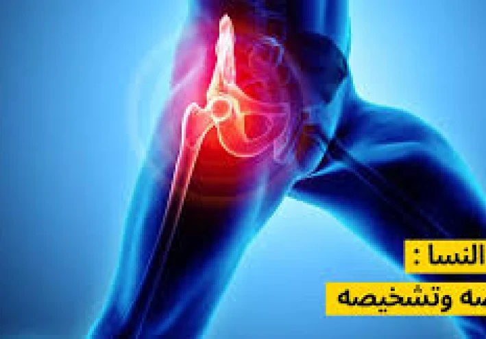 عرق النسا... الألم الصامت: عندما يصرخ العصب الأكبر في جسدك!