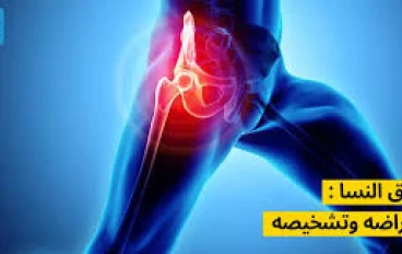 عرق النسا... الألم الصامت: عندما يصرخ العصب الأكبر في جسدك!