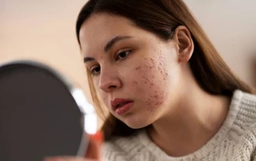 حب الشباب Acne