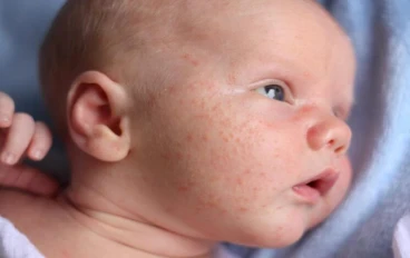 علاج حبوب الصيف عند الاطفال بكل بساطه 👶