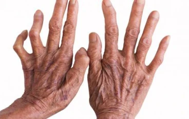 مرض الجذام.. بين الوصمة والعلاج: هل ما زال يشكل خطرًا؟