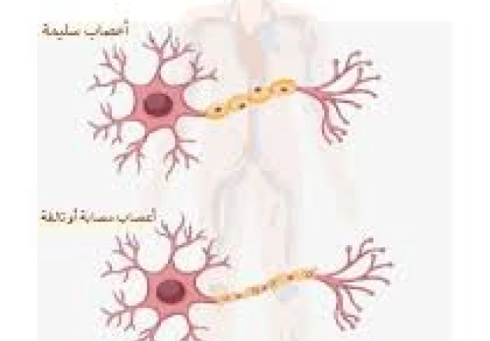 متلازمة غيلان باريه… المرض النادر اللي ممكن يقلب حياتك في أيام