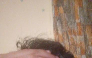 كيفية علاج الصلع الوراثي 