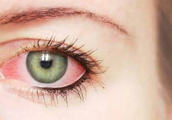 التهاب الملتحمة (Conjunctivitis)