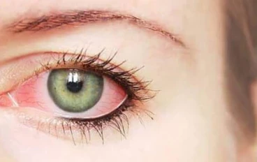 التهاب الملتحمة (Conjunctivitis)