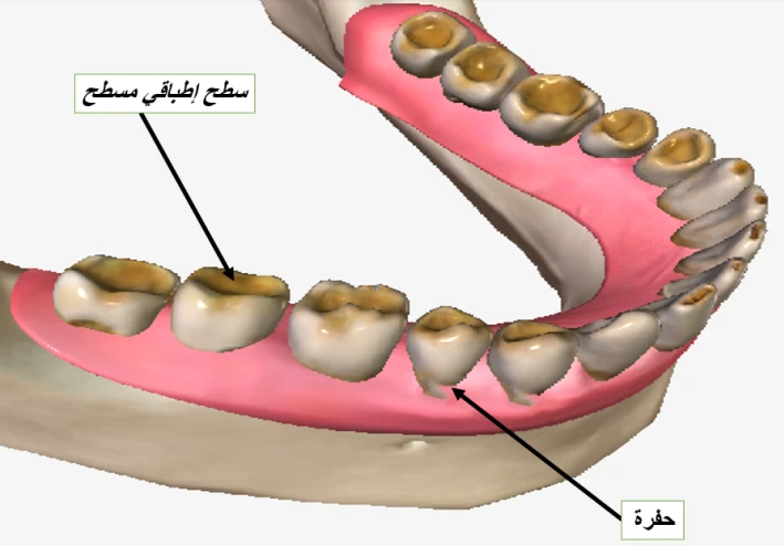 تآكل الأسنان: أسبابه، أعراضه، وطرق الوقاية