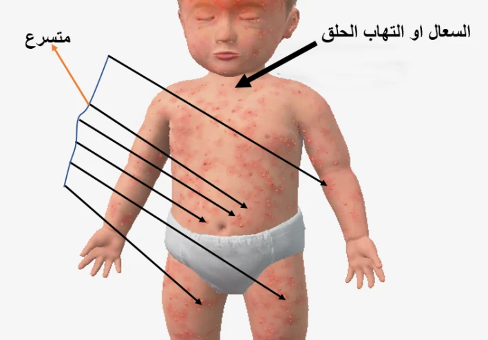 جدري الماء: مرض فيروسي معدٍ وطرق الوقاية منه