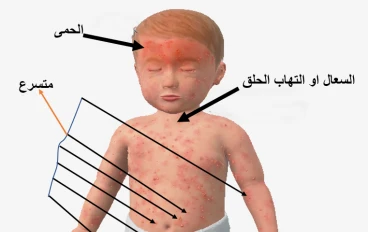 جدري الماء: مرض فيروسي معدٍ وطرق الوقاية منه