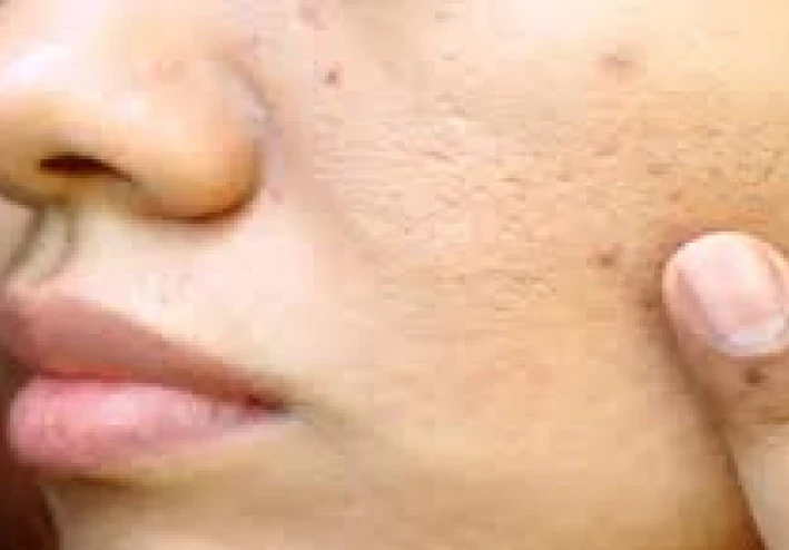 علاج الحبوب والهالات السوداء من الوجه: دليل متكامل للعناية والإشراق