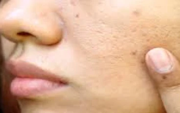علاج الحبوب والهالات السوداء من الوجه: دليل متكامل للعناية والإشراق