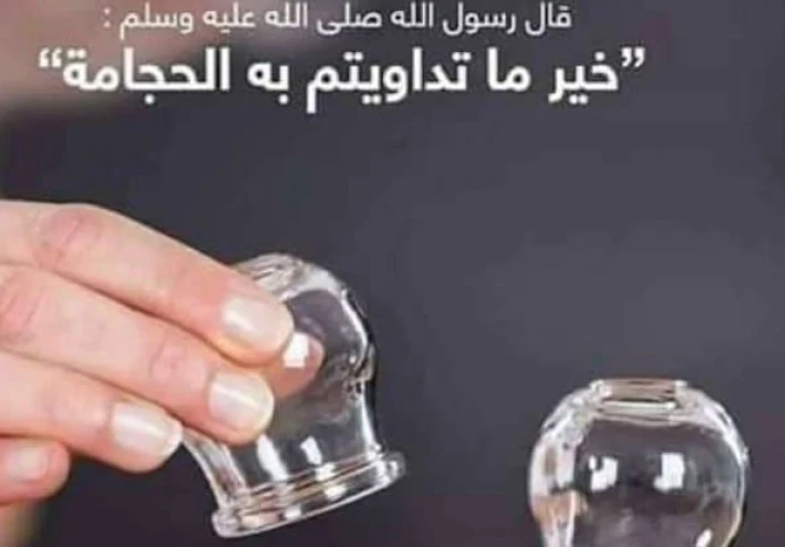 الحجامة.. طب بديل أم علاج طبيعي؟