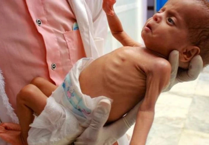 حياة الأطفال مهددة بسبب ارتفاع معدلات سوء التغذية في قطاع غزة