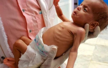 حياة الأطفال مهددة بسبب ارتفاع معدلات سوء التغذية في قطاع غزة