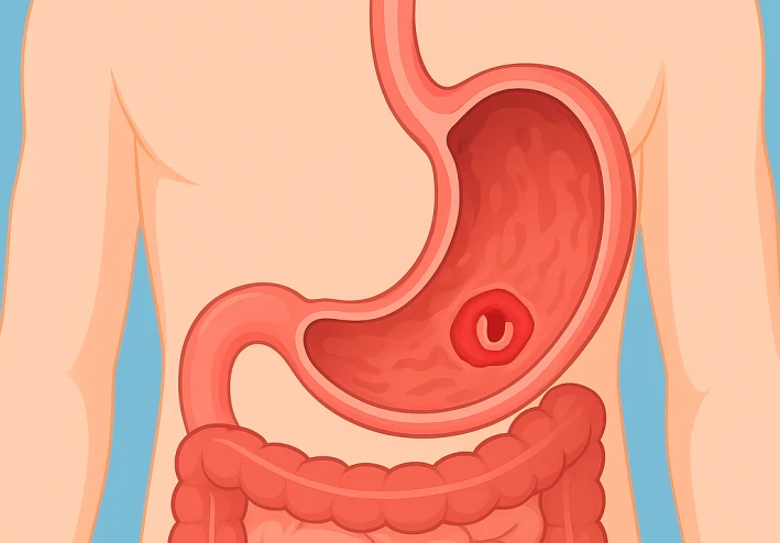 قرحة المعدة وأحدث طرق علاجها