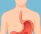 article image for قرحة المعدة وأحدث طرق علاجها