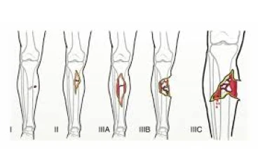 تصنيف جوستيلو (Gustilo Classification)