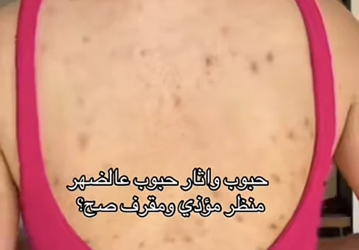 التخلص من حبوب الضهر والرقبه والزرعين