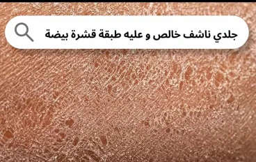 التخلص من جفاف الجلد وقشور الجلد في الصيف