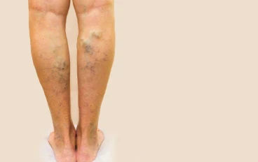 أفضل طرق علاج دوالي الساقين بدون جراحة