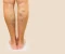 article image for أفضل طرق علاج دوالي الساقين بدون جراحة