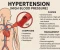 article image for Hypertension(High Blood Pressure) 