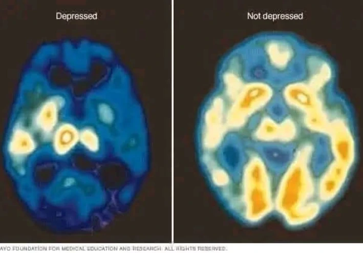 تأثير الاكتئاب على دماغك 