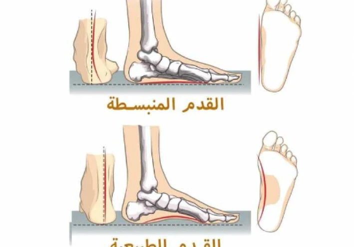 الفلات فوت عند الاطفال