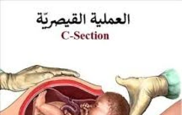الولادة القيصرية اضرار وفوائد