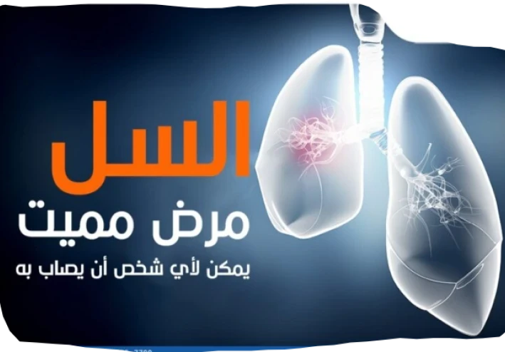 السل: الأعراض التفصيلية، طرق الانتقال، والوقاية والعلاج