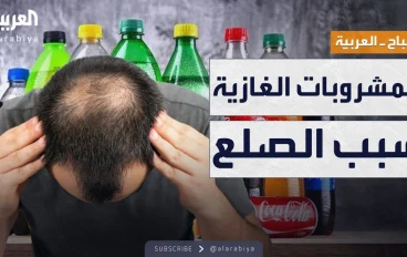 هل المشروبات السكرية تسبب تساقط الشعر؟ دراسة تكشف تأثيرها على شباب اليوم