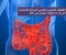 صورة مقال القولون العصبي: أسبابه وأعراضه وطرق العلاج