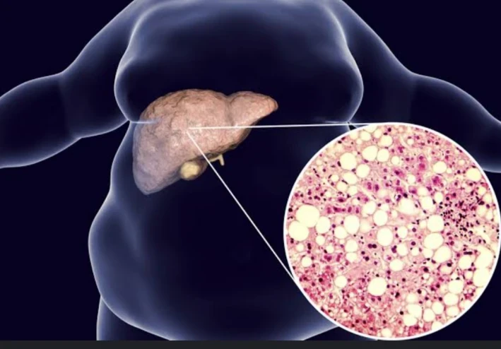 Fatty Liver: Causes, Types, Symptoms, Treatment, and the Essential Role of Nutrition
