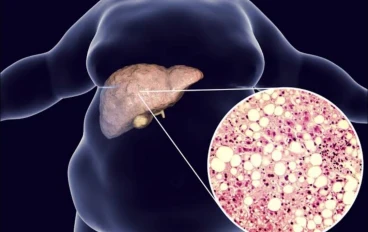 Fatty Liver: Causes, Types, Symptoms, Treatment, and the Essential Role of Nutrition