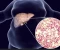 article image for Fatty Liver: Causes, Types, Symptoms, Treatment, and the Essential Role of Nutrition