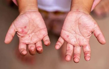 فيروس اليد والقدم والفم (HFMD): ما هو؟ وهل يشكل خطرًا؟